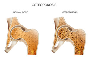 Elder Care Anderson OH - 5 Facts About Osteoporosis